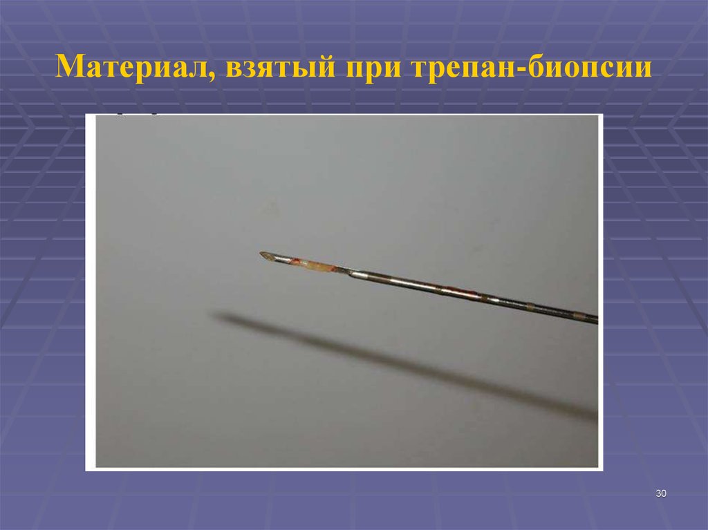Материал, взятый при трепан-биопсии