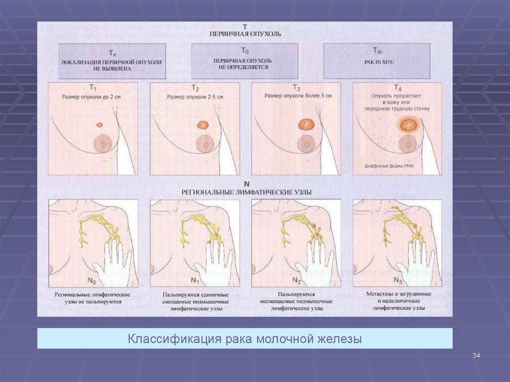 Рак молочной железы рисунок