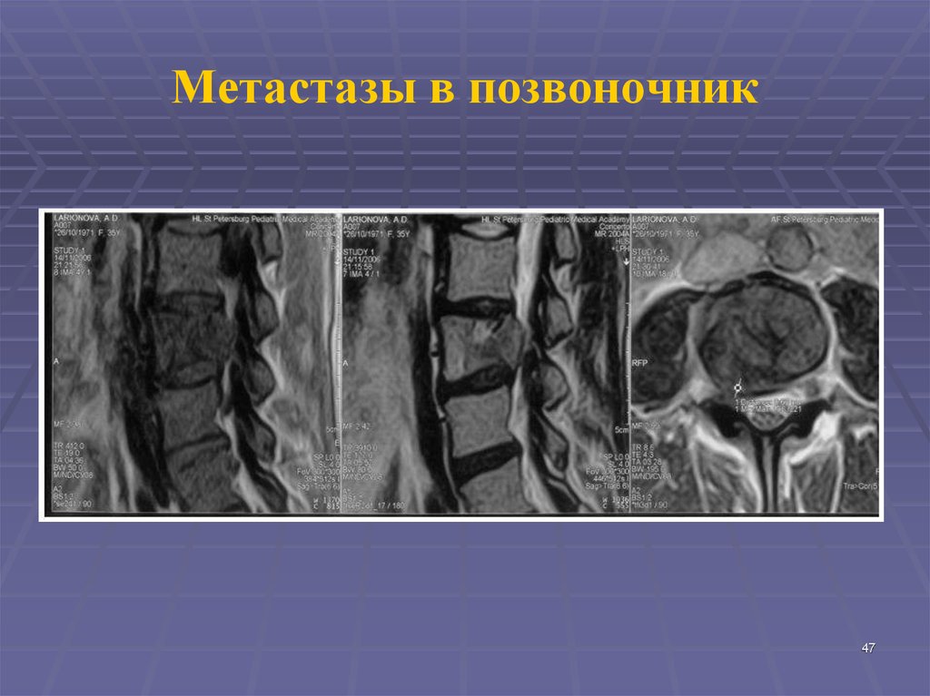 Метастаза кости позвоночника. Литические метастазы в позвоночнике кт. Метастаз в теле позвонка на мрт. Метастазы в позвоночнике на мрт.