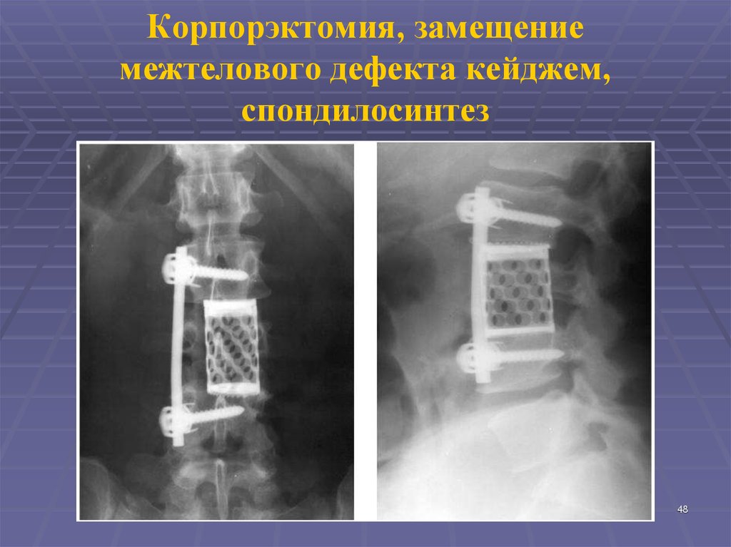 Корпорэктомия, замещение межтелового дефекта кейджем, спондилосинтез