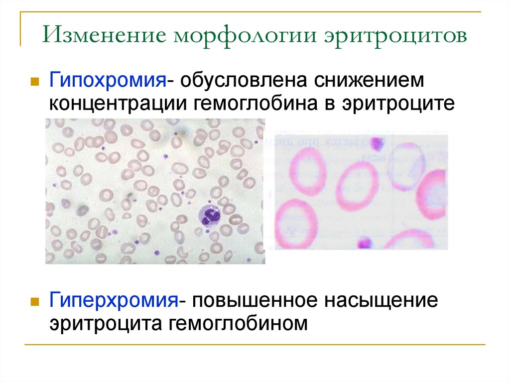 Гипохромия. Гипохромия и гиперхромия. Изменение морфологии эритроцитов при анемиях. Морфологии эритроцитов при в12. Гиперхромия эритроцитов показатели.