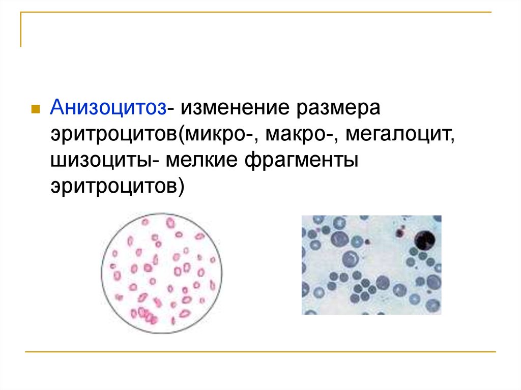 Анизоцитоз эритроцитов. Анизоцитоз мегалоциты. Смешанный анизоцитоз. Анизоцитоз микро. На клеточный анизоцитоз.