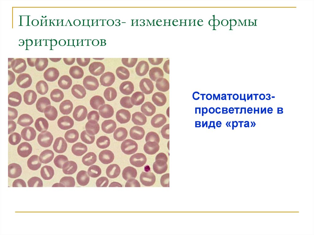 Пойкилоцитоз эритроцитов