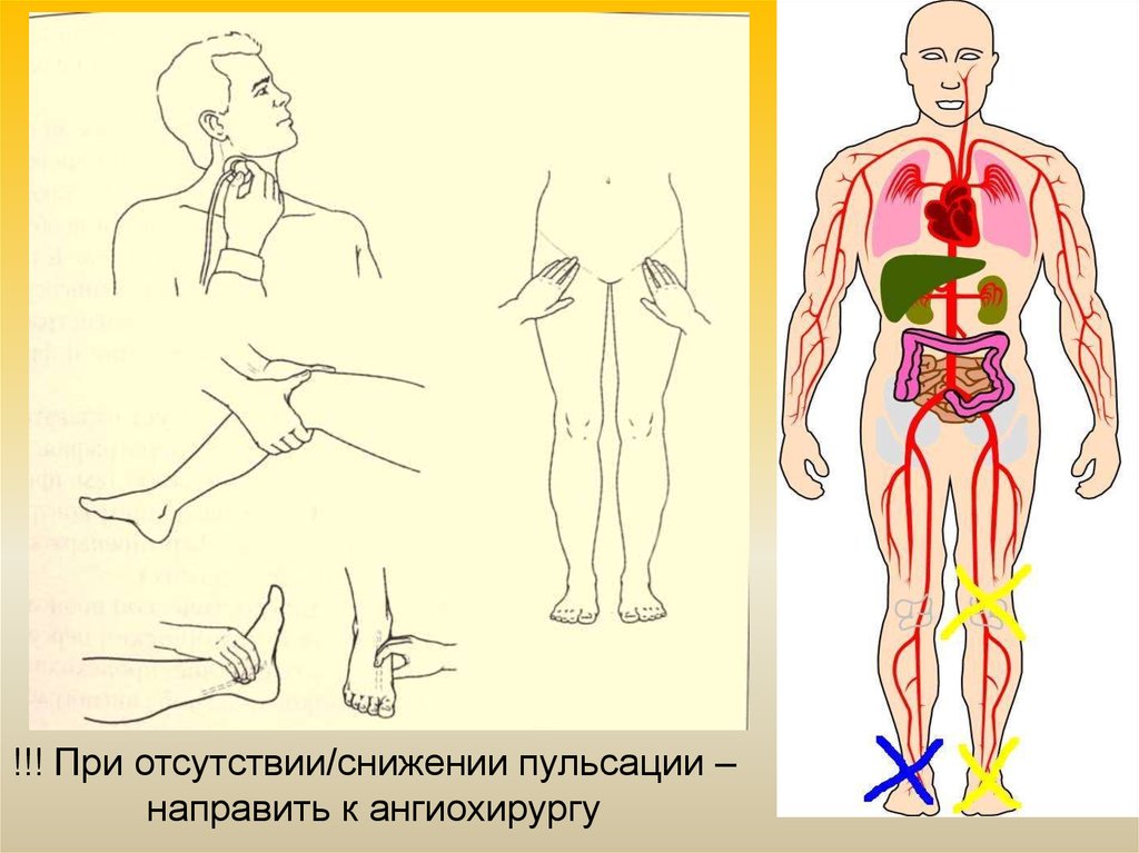 Хроническая артериальная недостаточность презентация хирургия