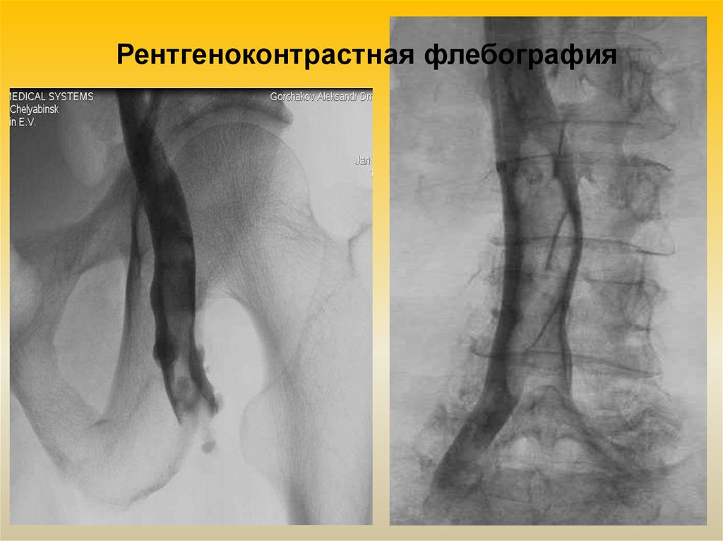 Флебография вен нижних. Флебография вен нижних конечностей. Ретроградная флебография.