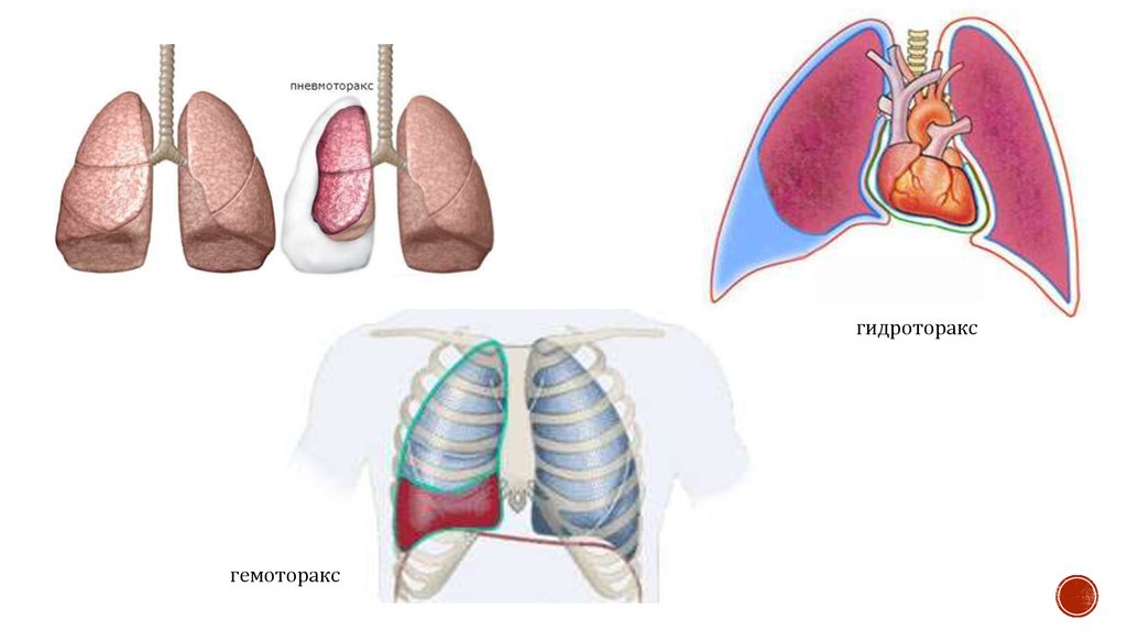 Презентация пневмоторакс и гемоторакс