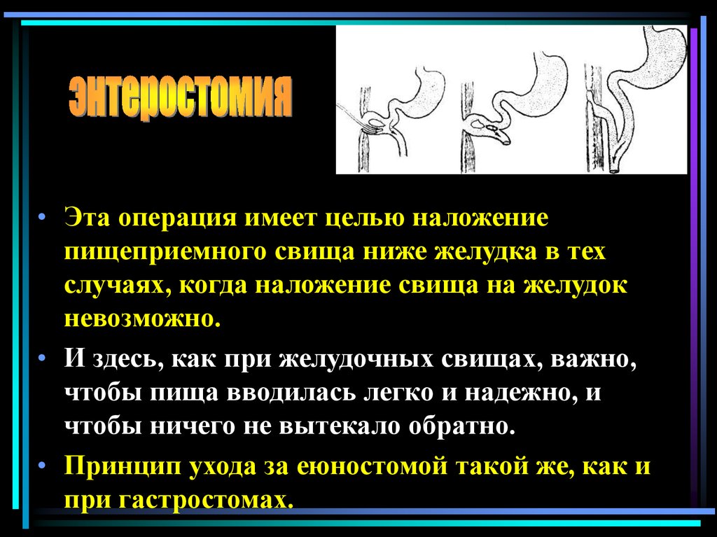 Свищи консервативное лечение. Наложение свища на желудок. Желудочно толстокишечный свищ. Наружный свищ желудка термины.