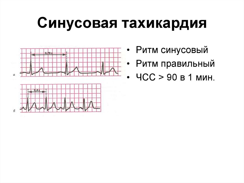 Тахикардия при беременности. ЭКГ при синусовой тахикардии. ЭКГ при синусовой тахикардии в норме. ЭКГ при синусовой тахикардии рисунок. Синусовая тахикардия схема ЭКГ.