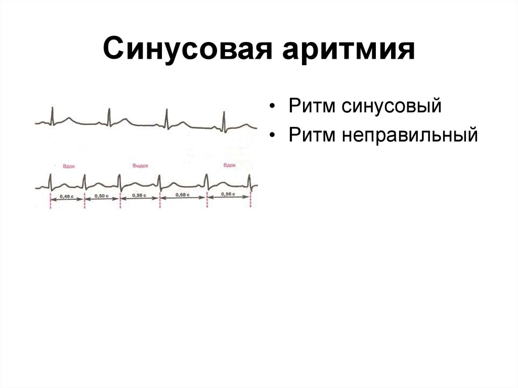 Что значит синусовый ритм сердца на экг. Синусовая аритмия на ЭКГ. ЭКГ при синусовой аритмии. Аритмия синусовая EKG. ЭКГ С синусовой аритмией сердца.