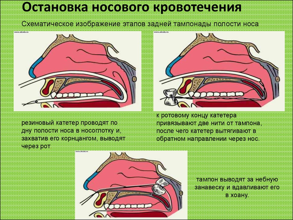 Носовое кровотечение у ребенка карта вызова