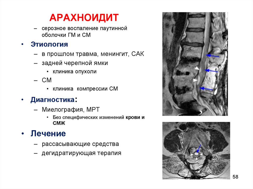 Оболочки мозга мрт