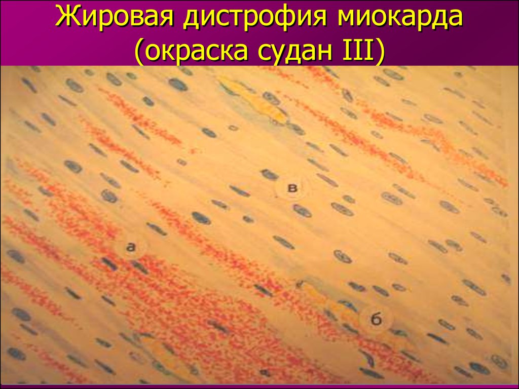 Жировая дистрофия миокарда (окраска судан III)