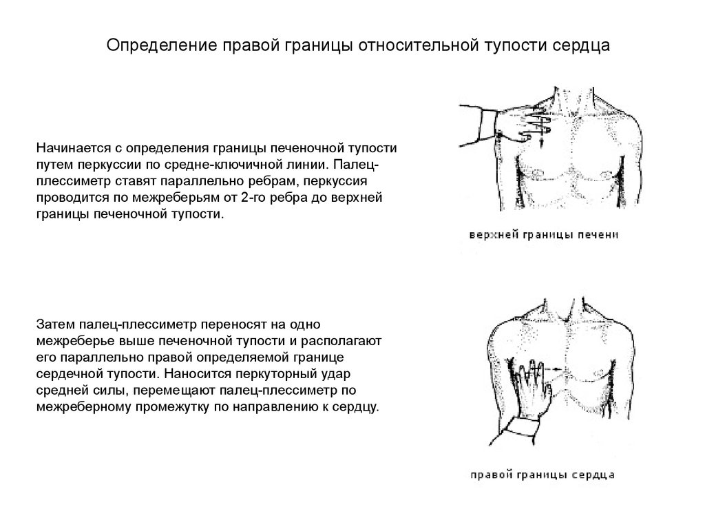 Тупость сердца. Границы относительной тупости сердца перкуссия. Определение границ относительной сердечной тупости. Методика определения границ относительной сердечной тупости. Перкуссия верхней границы сердца.