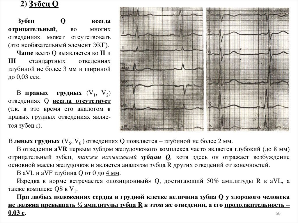 Р q s. Зубец q II III AVF. Зубец q в 3 отведении и AVF В норме. ЭКГ зубец t отрицательный в v1. ЭКГ зубец q в AVF.