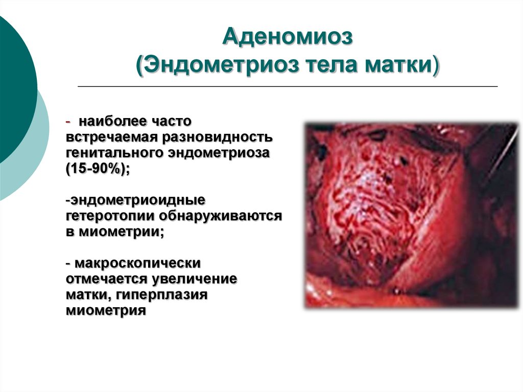 Узи эндометриоз матки фото