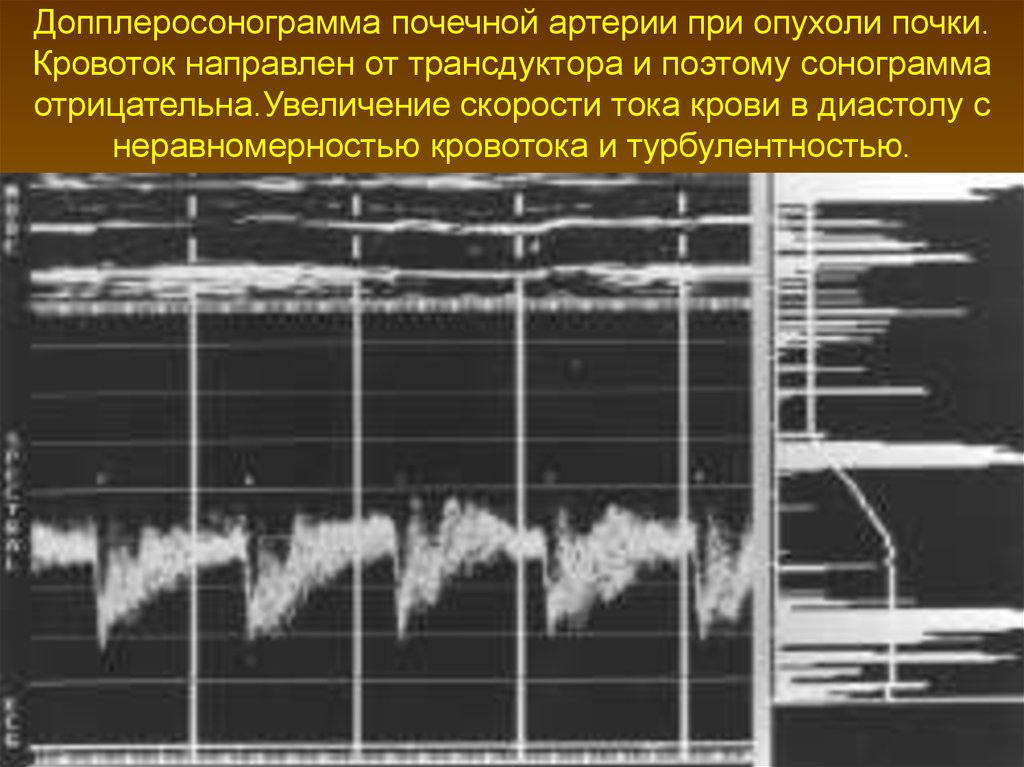 Отрицательное увеличение. Кровоток в почечных артериях. Скорости в почечных артериях. Оценка кровотока в почечный артерии. Спектр кровотока в почечных артериях.