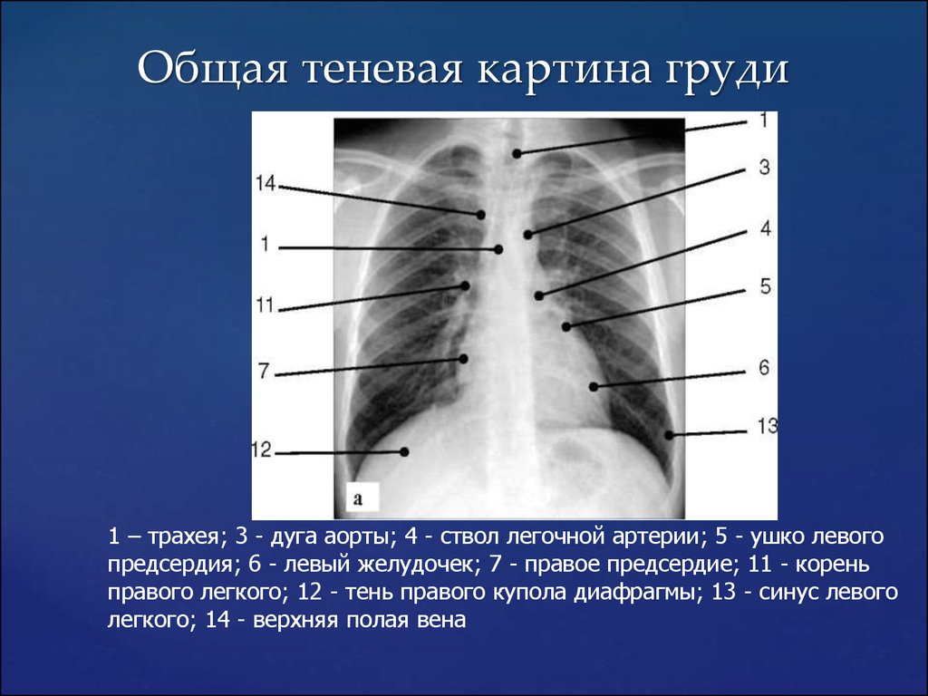 Границы расширены влево. Средостение рентген анатомия. Дуги средостения рентген. Дуга аорты анатомия рентген. Грудная клетка рентген анатомия.