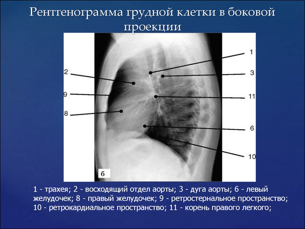 Рентгенограмма в боковой проекции. Рентген ОГК боковая проекция. Рентгенография ОГК норма боковая проекция. Левая боковая проекция грудной клетки рентген. Рентген легких боковая проекция норма.