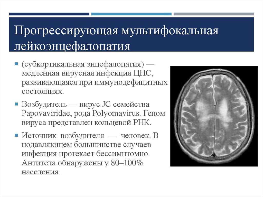 Многоочаговое поражение мозга. Прогрессирующая мультифокальная лейкоэнцефалопатия кт. Прогрессирующая мультифокальная лейкоэнцефалопатия (ПМЛ). Прогрессирующая мультифокальная лейкоэнцефалопатия гистология. Лейкоэнцефалопатия головного мозга мрт.