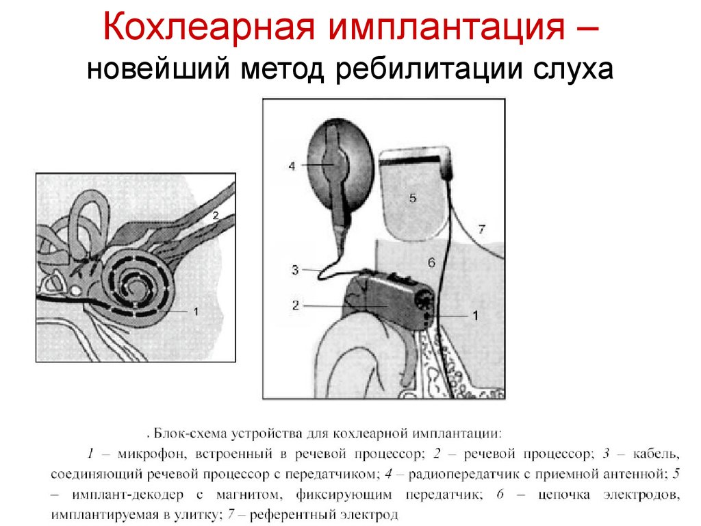 Схема работы кохлеарного импланта