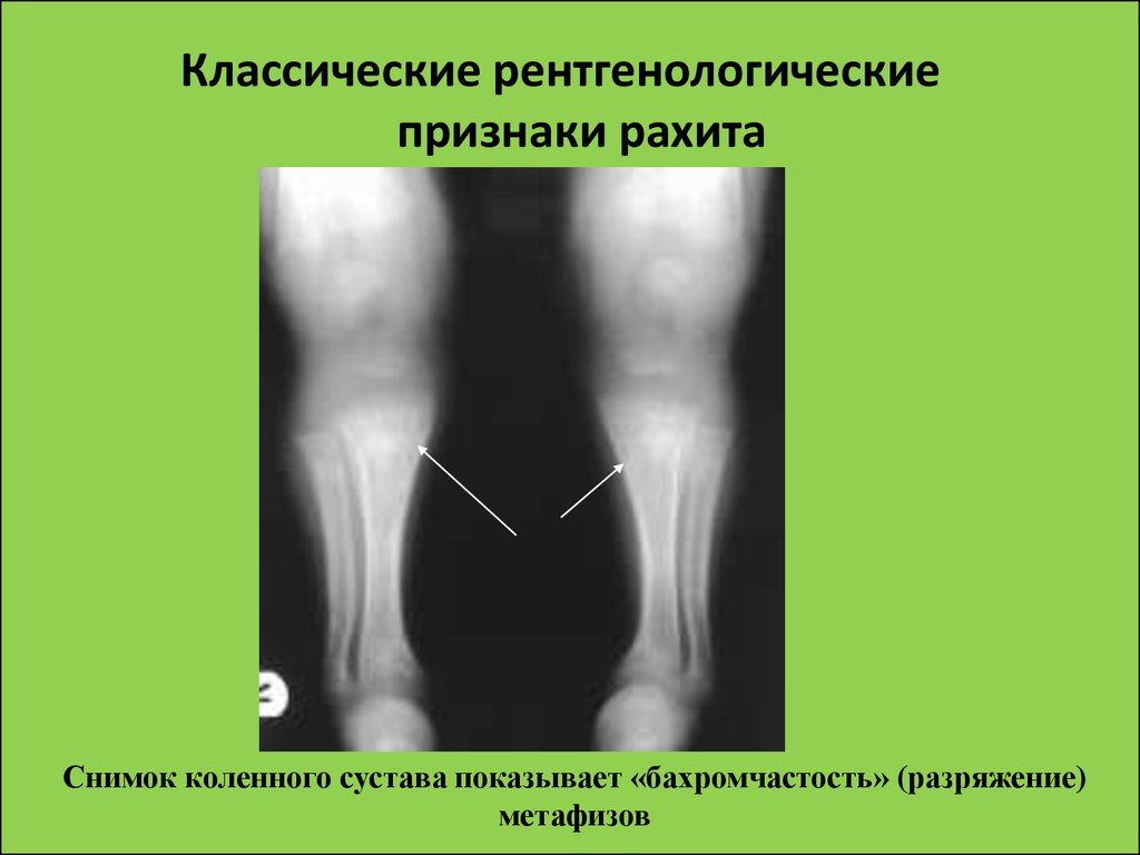 Для разгара рахита характерна следующая рентгенологическая картина