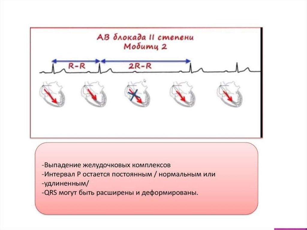 Выпадение желудочкового комплекса. Выпадение трех желудочковых комплексов подряд. Удлинение расстояния между желудочковыми комплексами. Выпадение каждого 2 желудочкового комплекса. Пузыри 3 желудочковой стадии.