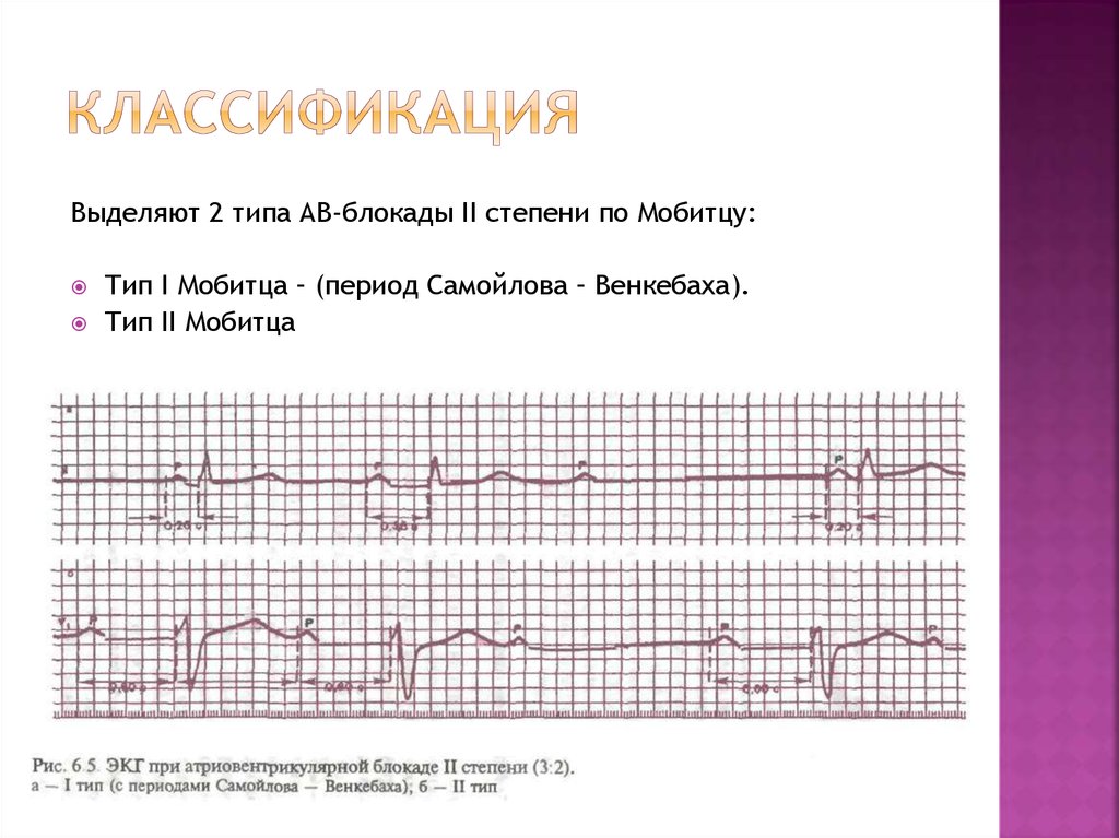 Ав блокада 2 степени. АВ блокада 2 степени Самойлова Венкебаха. АВ блокада 2 степени Мобитц 1 с периодикой Самойлова Венкебаха. AВ блокады 2 степени с периодами Самойлова Венкебаха. Периоды Самойлова-Венкебаха на ЭКГ.