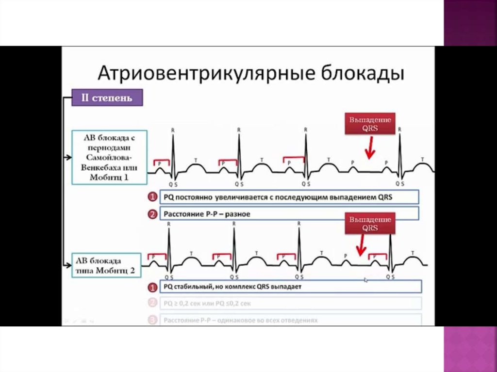 Ав блокады на экг картинки