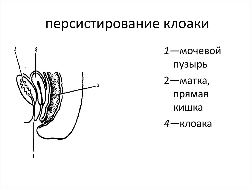 Матка мочевой. Персистирование клоаки. Мочевой пузырь и прямая кишка. Персистирование клоаки у человека.