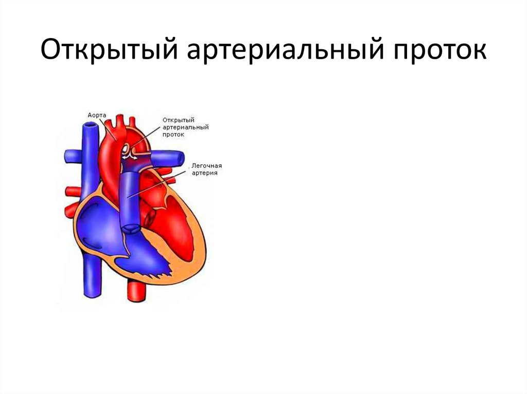 Функционирующий артериальный проток. Врожденный порок сердца открытый артериальный проток. Открытый артериальный (боталлов) проток (ОАП).