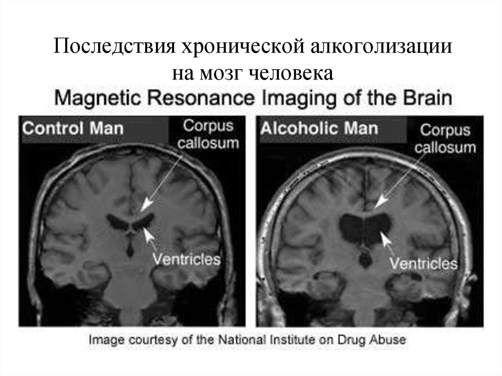 Последствия хронической алкоголизации на мозг человека