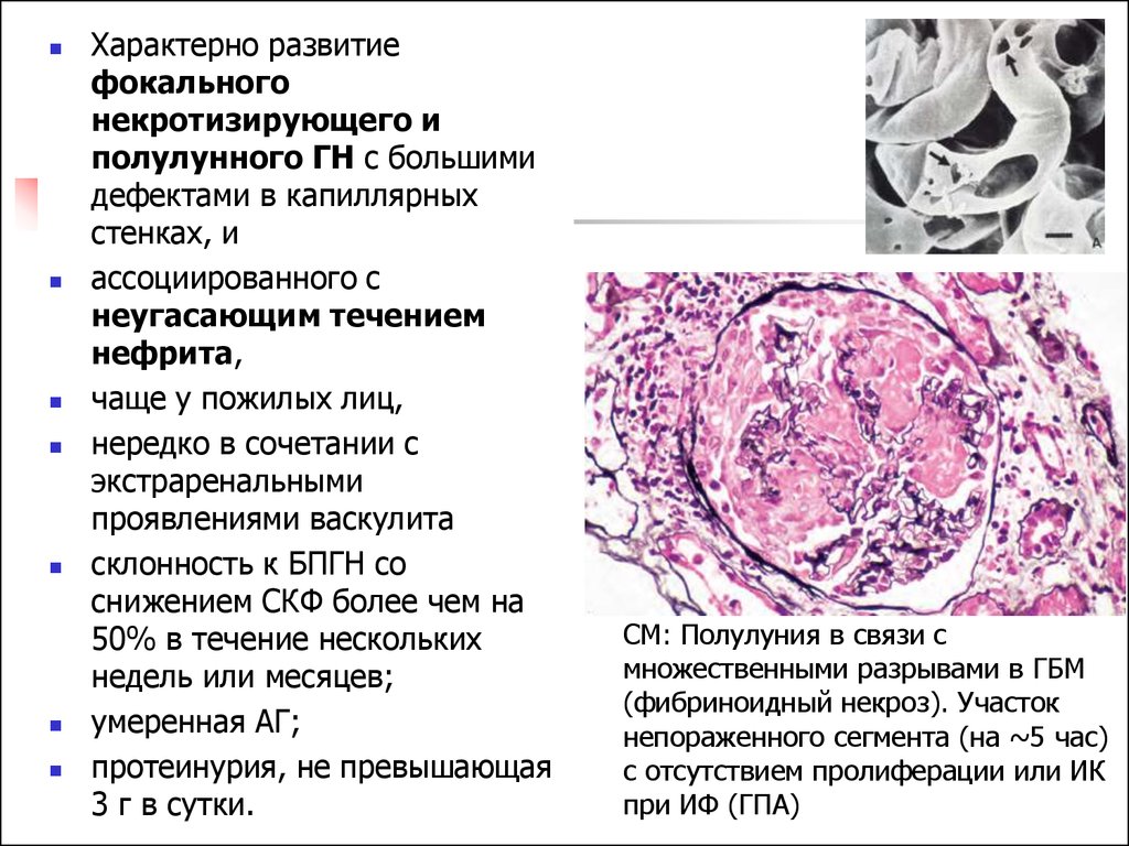 Развитие васкулитов