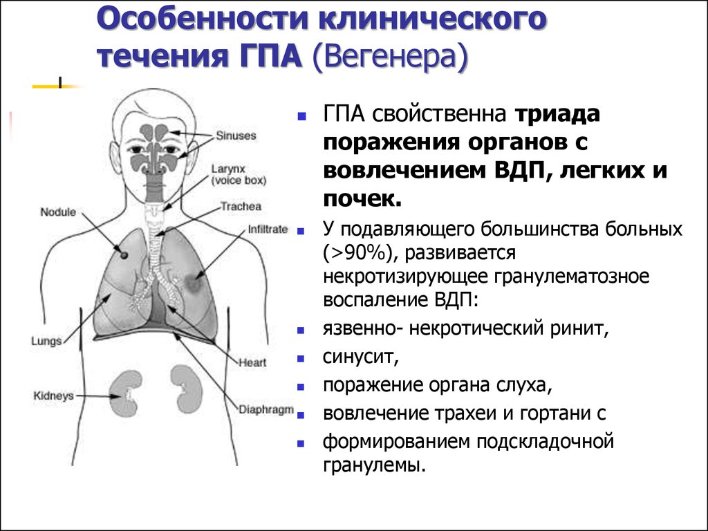 Системные васкулиты клинические. @Evgehka10041990:гранулематоз Вегенера. Болезнь Вегенера этиология. Клинические диагноз гранулематоз Вегенера.