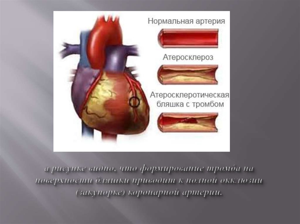Тромб и бляшка разница. Закупорка коронарной артерии. Непроходимость коронарных сосудов. Окклюзия коронарных сосудов. Сердце коронарные сосуды окклюзия.