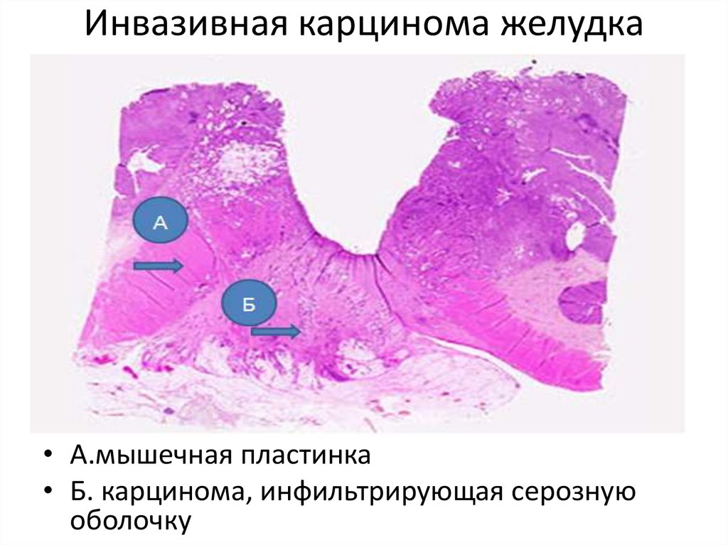 Инвазивная карцинома это что значит