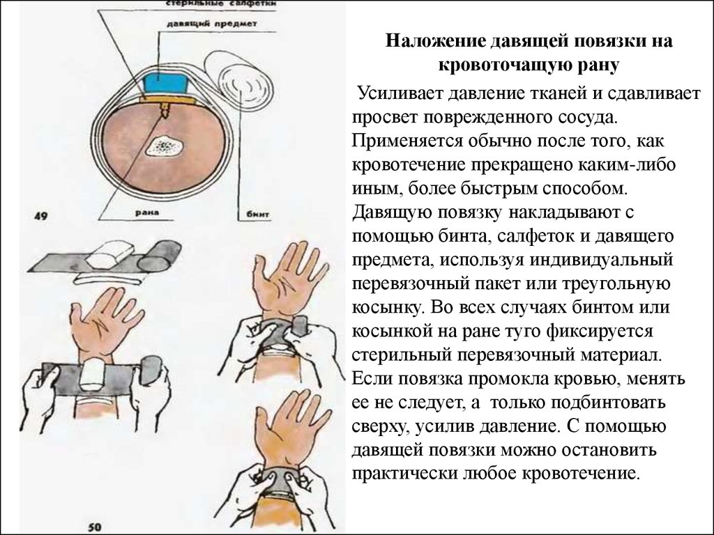 Наложение давящей повязки рисунок