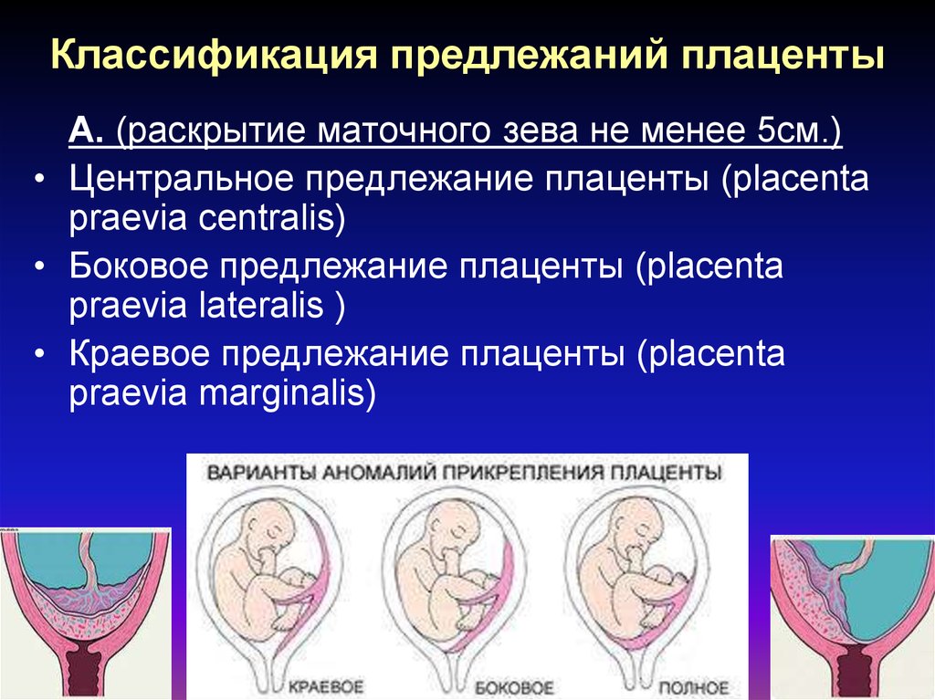 Полное предлежание при беременности. Краевое предлежание плаценты. Центральное предлежание плаценты при беременности. Боковое и краевое предлежание плаценты. 5. Классификация предлежания плаценты..