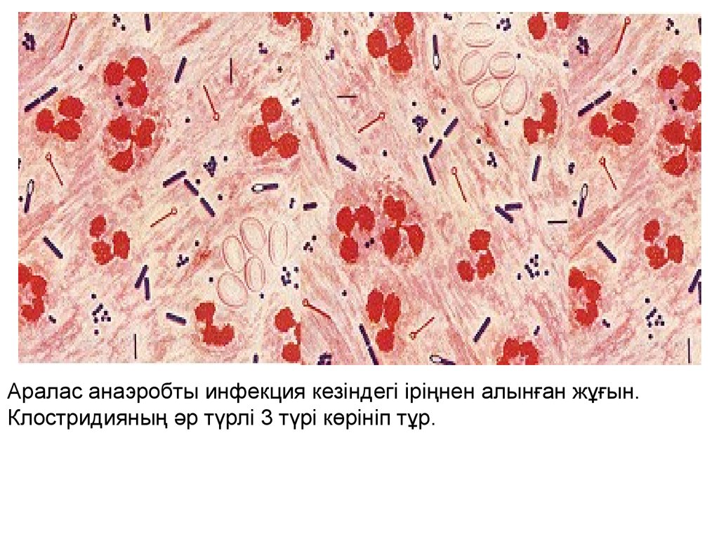 Аралас анаэробты инфекция кезіндегі іріңнен алынған жұғын. Клостридияның әр түрлі 3 түрі көрініп тұр.