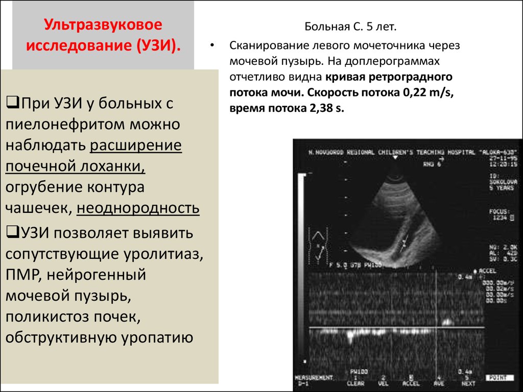 Узи больно. Протокол УЗИ мочевого пузыря нейрогенный мочевой пузырь. Нейрогенный мочевой пузырь на УЗИ заключение. УЗИ при острой задержке мочи. Острая задержка мочи УЗИ.