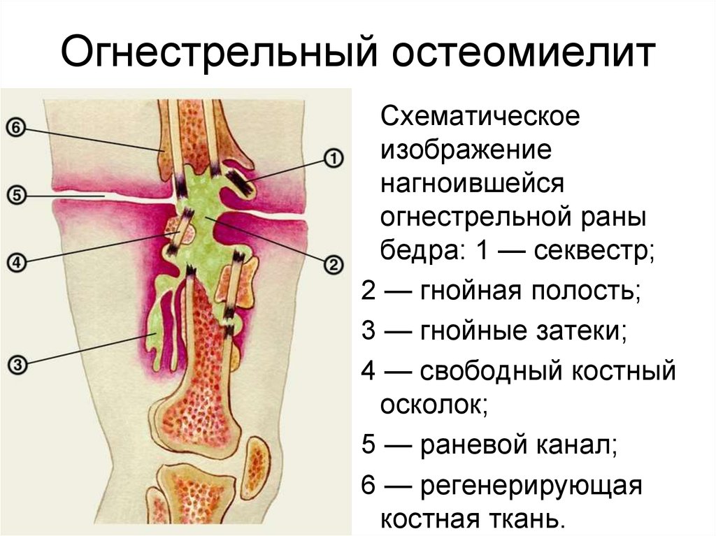 Острый остеомиелит клиническая картина