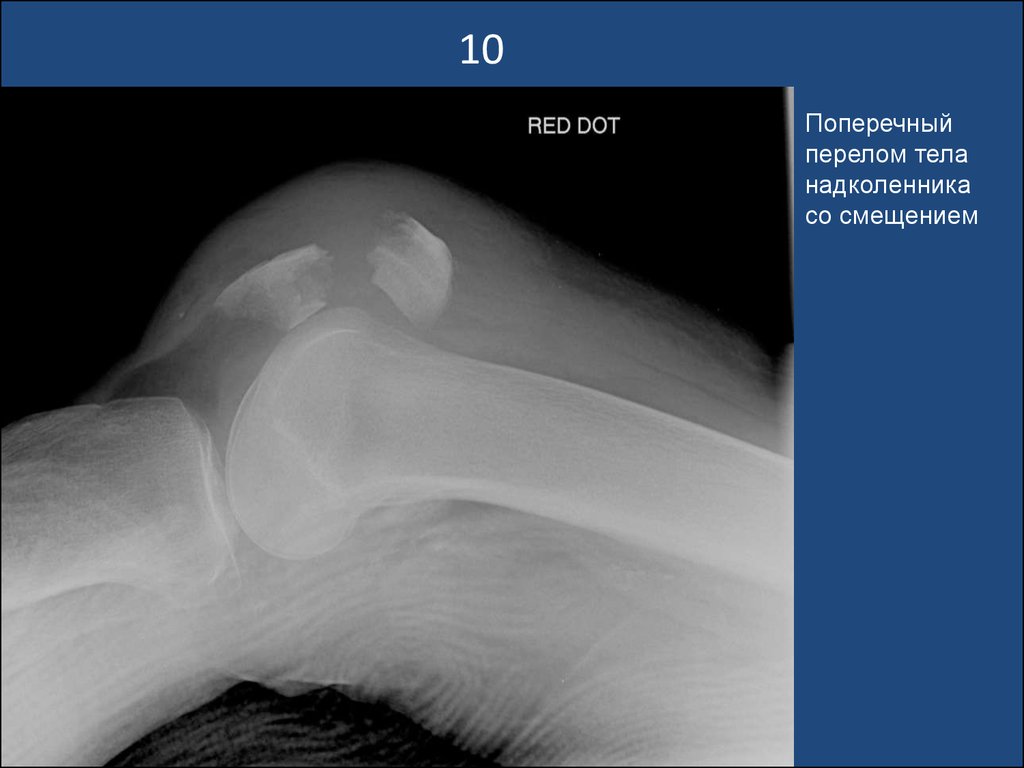 Перелом надколенника без смещения. Закрытый краевой перелом надколенника. Акромиальный конец ключицы перелом со смещением. Перелом коленной чашечки рентген. Несросшийся перелом надколенника.