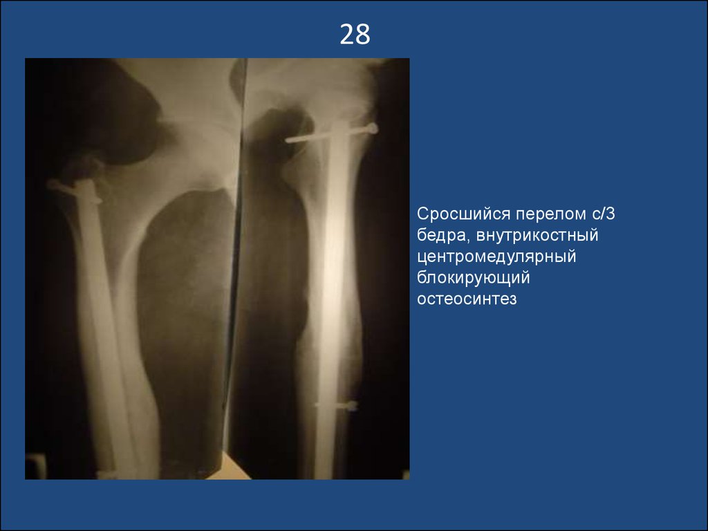 Сколько срастается трещина. Сросшийся перелом бедра рентгенограмма. Сросшийся перелом бедренной кости рентген. Сросшийся перелом шейки левой бедренной кости. Перелом н/3 бедренной кости.