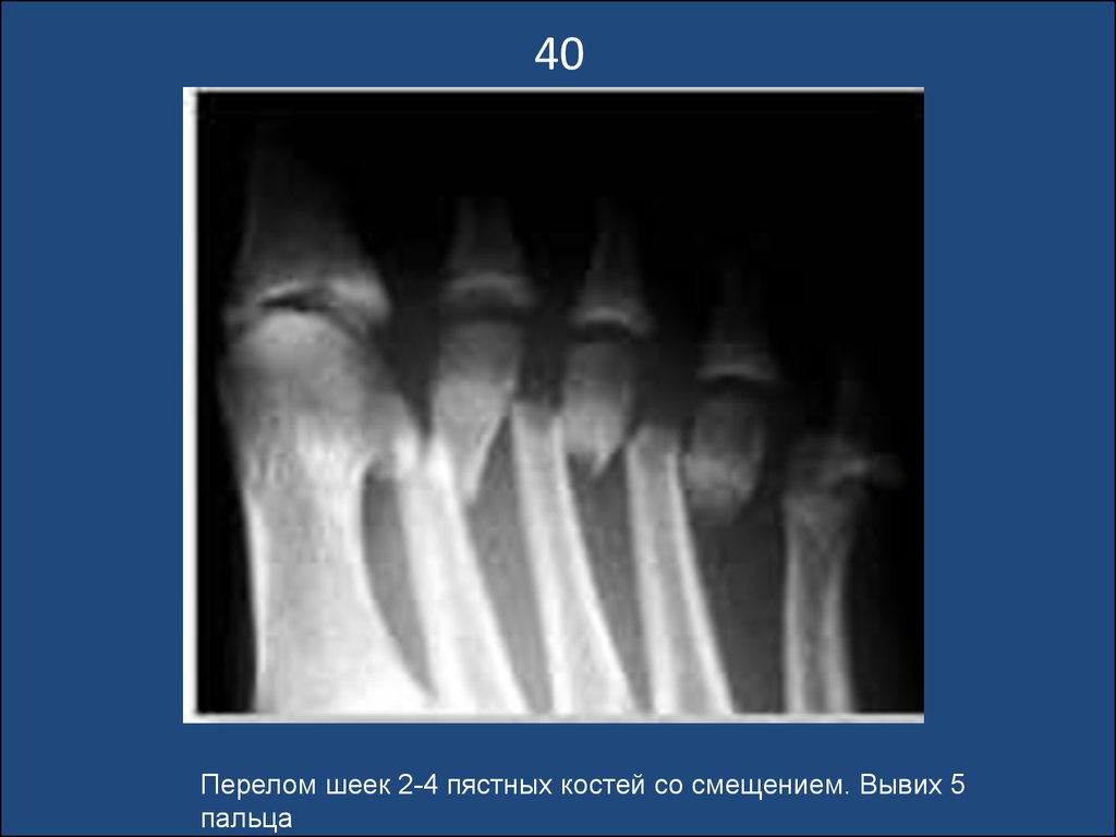 2 пястная кость. Перелом шейки 5 пястной кости. Вывих пястных костей рентген. Вывих 4 пястной кости кисти.