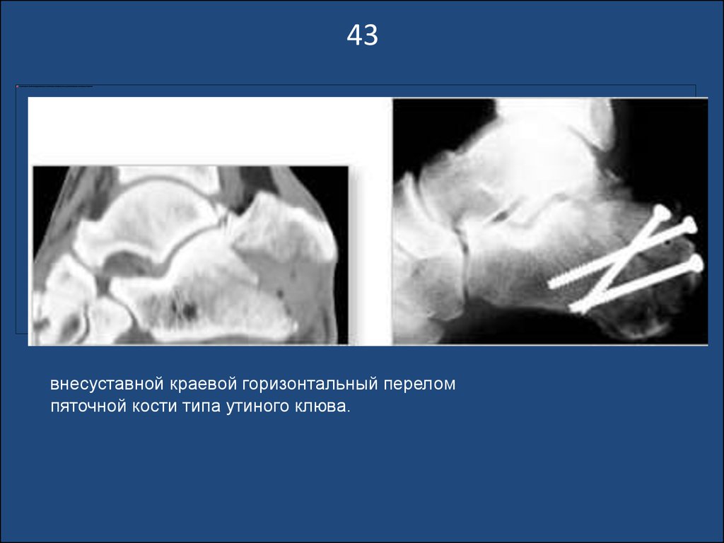 Отрывной перелом. Перелом пяточной кости по типу утиного клюва. Горизонтальный перелом пяточной кости. Краевой перелом пяточной кости. Утиный клюв перелом пяточной кости.