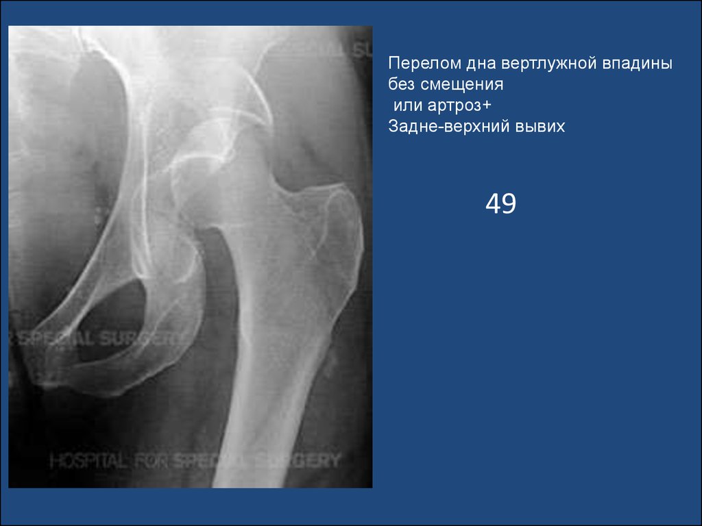 Перелом вертлужной впадины. Рентгенограмма перелом вертлужной впадины. Перелом заднего края вертлужной впадины рентген. Центральный перелом вертлужной впадины. Перелом дна вертлужной впадины на рентгене.