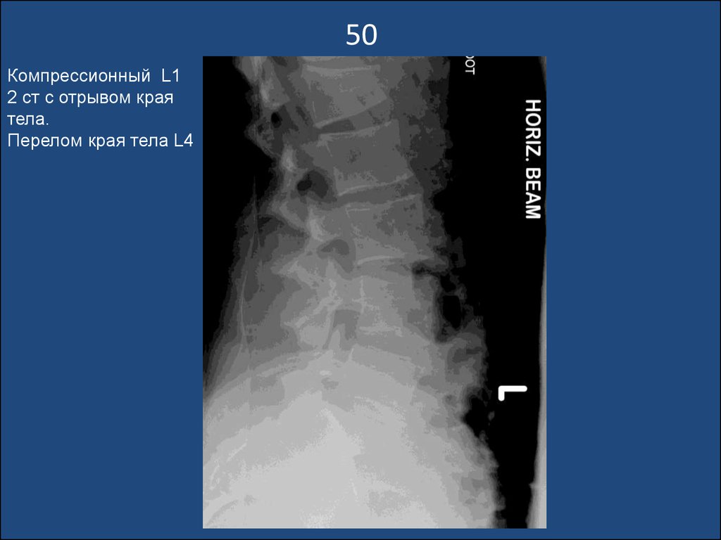 Компрессионный перелом тела 1 1. Компрессионный перелом l1 рентгена. Компрессионный перелом тела l2 , l4 1 ст.. Компрессионный перелом тела th7. Компрессионный перелом позвоночника рентген.