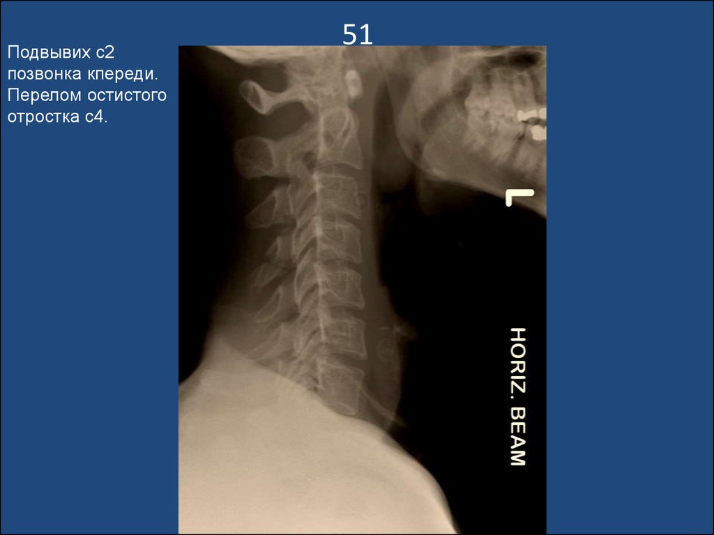 Подвывих позвонка. Подвывих с2 шейного позвонка на рентгене. Подвывих зубовидного отростка с2 позвонка рентген. Перелом остистого отростка с1. Подвывих 7 позвонка.