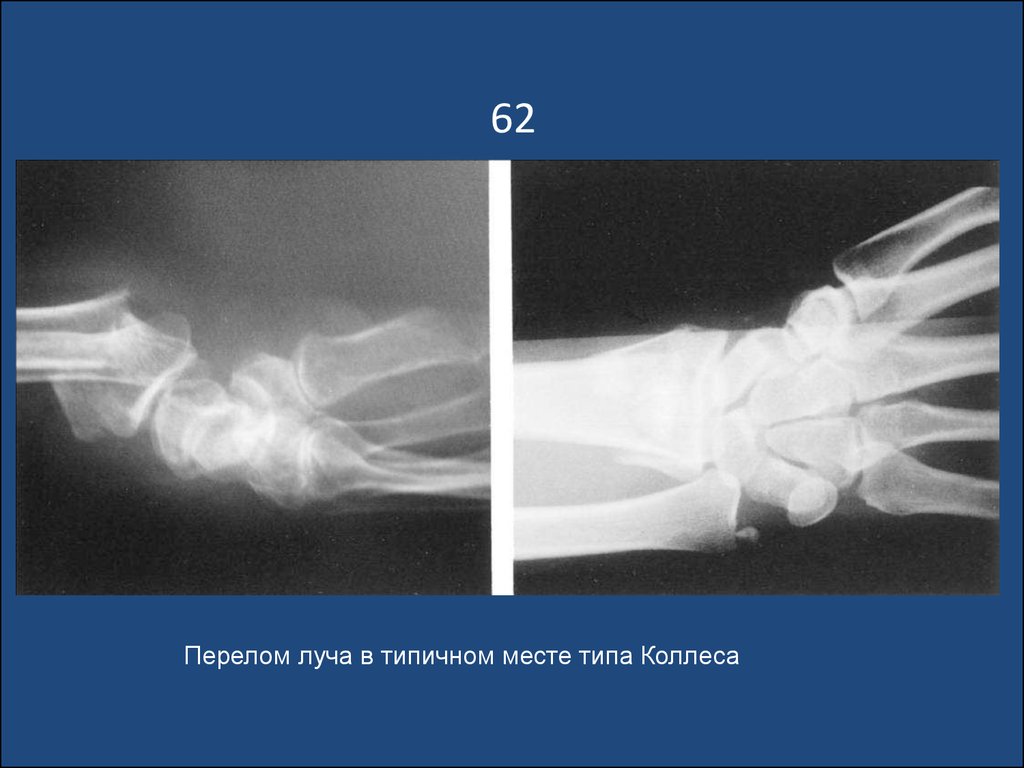 Место перелома слома 6 букв сканворд