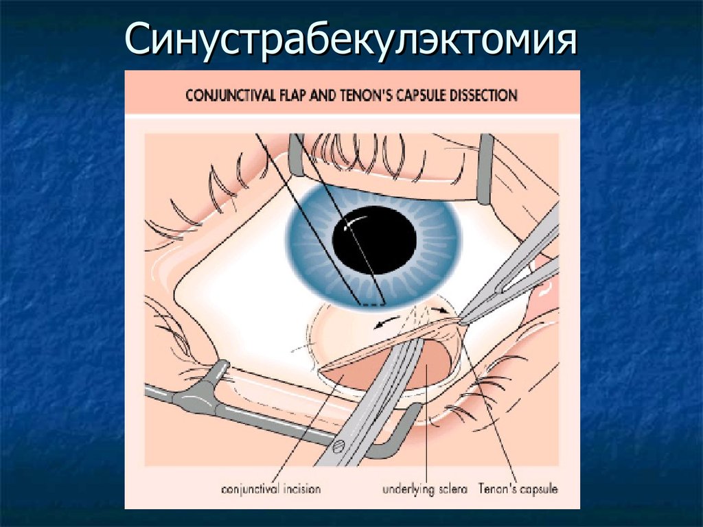 Глаукома операция. Непроникающая синустрабекулэктомия. Синустрабекулэктомия этапы. Операция глаукома синустрабекулэктомия. Стнус трабекул эктомия.