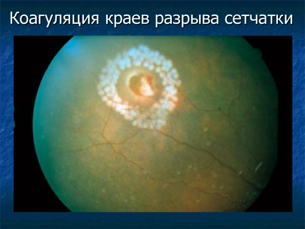 Сетчатка армия. Периферическая лазеркоагуляция сетчатки глаза. Периферическая витреохориоретинальная дегенерация сетчатки глаза. Периферическая отслойка сетчатки. Отслойка сетчатки глазное дно.